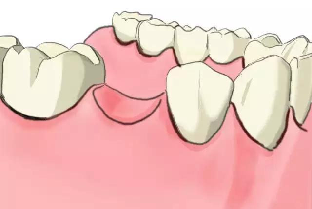 种植牙步骤及注意事项(种牙需要注意的问题以及如何保护种牙)
